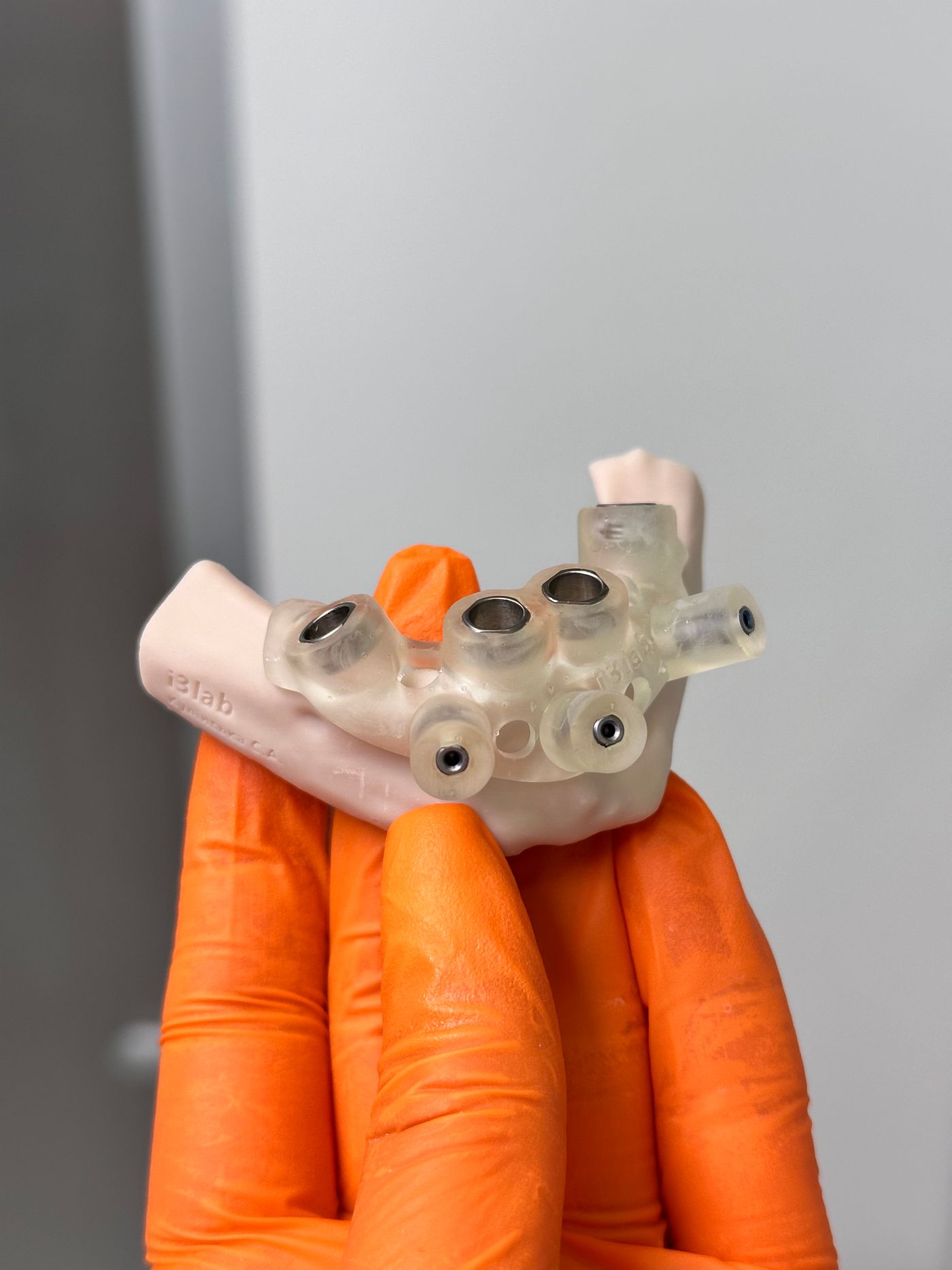 Gedruckte Bohrschablone mit Führungshülsen für die Implantatinsertion